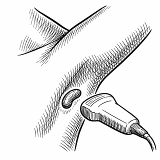 Why Your Armpit Might Get Its Own 3D Photoshoot: The Future of Breast Cancer Staging